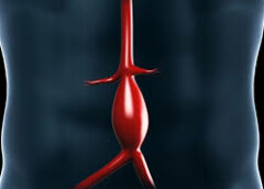 Ανεύρυσμα κοιλιακής αορτής: Τα ύπουλα σημάδια ρήξης και ποιοι κινδυνεύουν περισσότερο